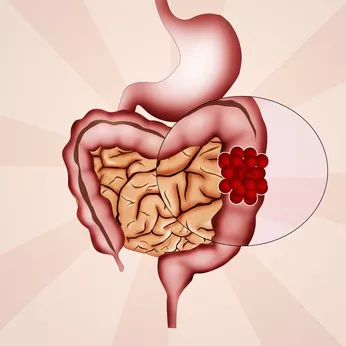 Les médecins repartent à la chasse au cancer colorectal